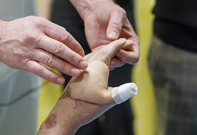 Elektřina ho skoro zabila, před amputací mu lékaři zachraňovali znetvořenou ruku