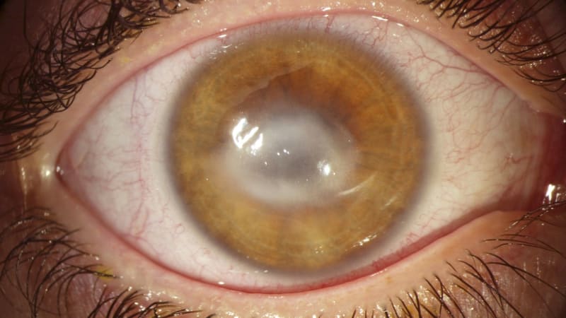 Parazit, který požírá oči: Ohrožuje hlavně nositele čoček, varují vědci. Může způsobit slepotu