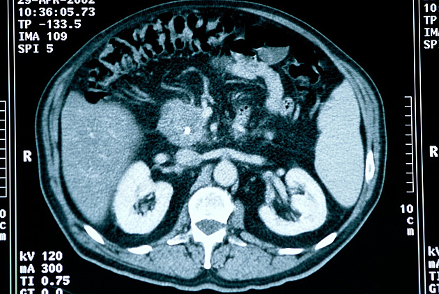 Cukrovka i rodinná historie. Nové prohlídky pomohou čelit rakovině slinivky