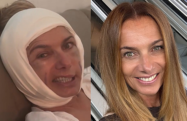 Jsem v přechodu, zhubla jsem a živím se obličejem, vysvětluje plastiky Bendová